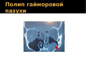 Полип в верхнечелюстной пазухе