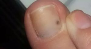 Коричневое пятно возле ногтя на ноге