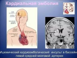 Допустимая нагрузка после инсульта. Диагноз-ишемический(атеротромботический)  инсульт в бассейне ЛСМА,
