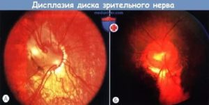 Дисплазия диска зрительного нерва