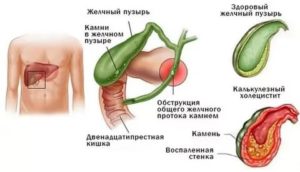 Крапивница и патология желчного пузыря взаимосвязь