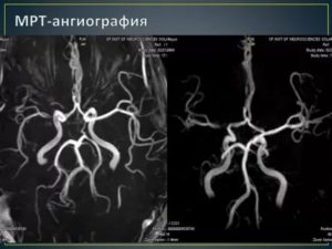 Расшифровка МРТ и МРА, артерии головного мозга