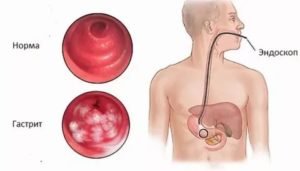 Недостаточность кардии, гастрита, дуоденита