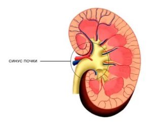 Признаки расщепления почечного синуса справа