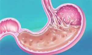Недостаточность кардии, гастрита, дуоденита