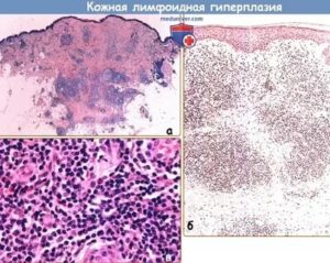 Лимфофоликулярная гиперплазия