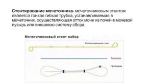 Стентирование мочеточника