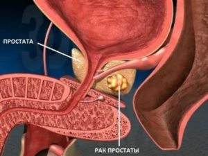 Пропала сперма после осмотра простаты