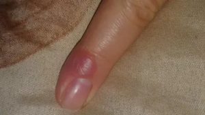 Полупрозрачная шишка возле ногтя на пальце руки