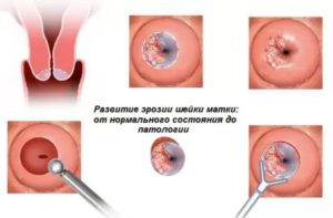 Радиоволновая конизация