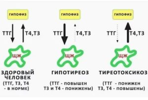 Узел в щетовидной железе и низкий ттг