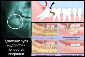 Боль и неприятный запах после удаления зуба мудрости нижней челюсти