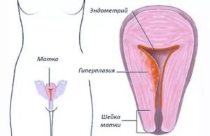 Гиперплазия эндометрия и обильные месячные