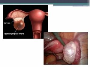 Лечение кисты яичника