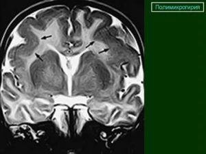 Каковы последствия полимикрогирии?