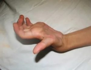 Кривой и болит палец после перелома