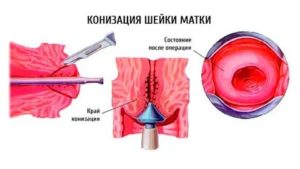 Конизация шейки матки