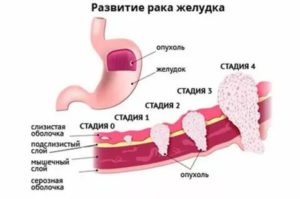 Чем обезболить рак языка 3 степени