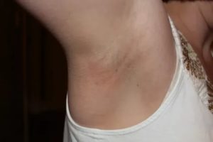 Уплотнение ближе к подмышке