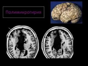 Каковы последствия полимикрогирии?