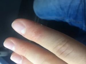 Уплотнения и трещины на пальцах рук