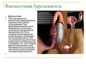 Как избежать повторной внематочной беременности?