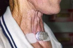 Диагноз рак голосовых связок. После облучения сильно болит горло