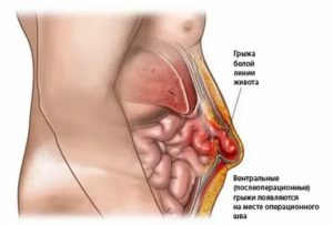 Боль в области желудка после удаления аппендицита