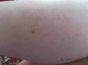 Непонятная сыпь под кожей