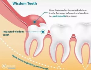 Можно ли удалять зуб мудрости при простуде