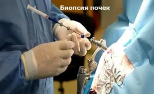 Биопсия почек в Москве