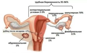 Боли в матке при ходьбе