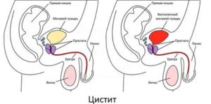 Боли при сексе с полным мочевым пузырём