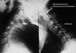 Функциональный блок на рентгенограмме