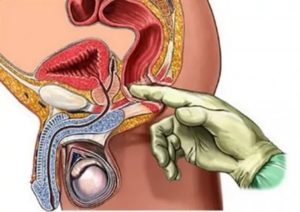 Пропала сперма после осмотра простаты