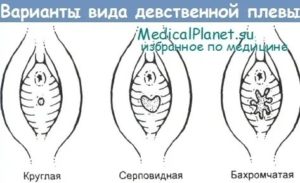 После лишения девственности больно писать