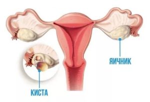 Последствия ошибки принятия регивидона для избавления от фолликулярной кисты