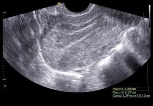 Плодовое яйцо в полости матки не лоцируется