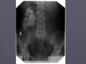 Затемнение в почке