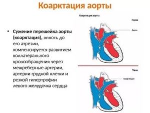 Гипоплазия восходящего отдела аорты