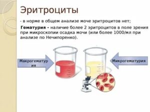 Повышены эритроциты в моче