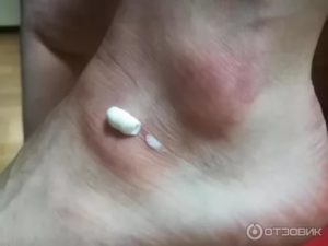 Мозоль на соске? Или застой?