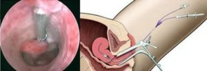 Половая жизнь после гистероскопии