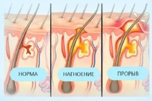 Как ухаживать за фурункулом с резинкой?