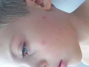 Вечером поднимается температура и у ребенка появляется сыпь