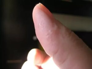 Прозрачные пузырьки на пальцах рук