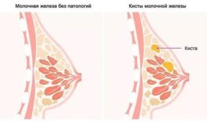 Грудь перед месячными твёрдая