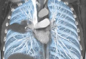 Кт лёгких органы грудной клетки