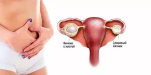 Киста яичника. Жжение внизу живота