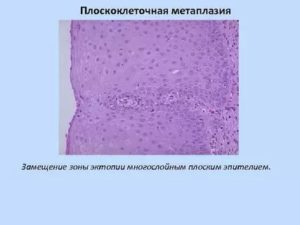 Эктопия плоскоклеточная метаплазия